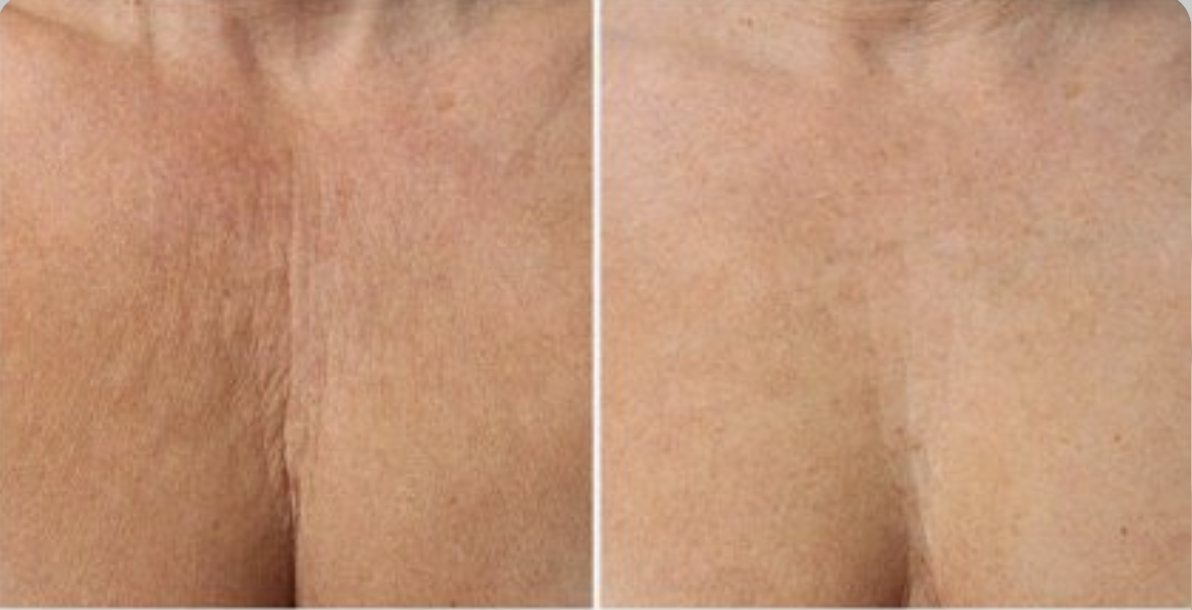 Décoletté abimé Avant Après à Marseille 