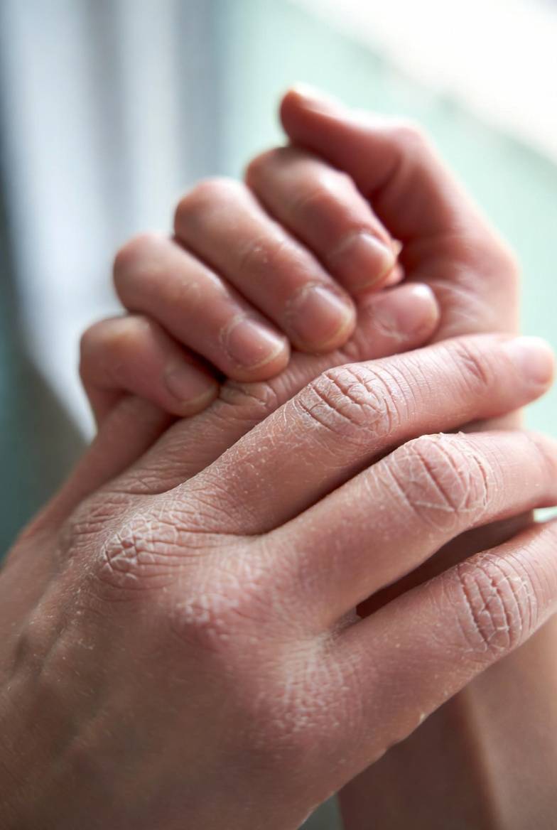 Hydratation des mains par injection d'acide hyaluronique à Marseille 